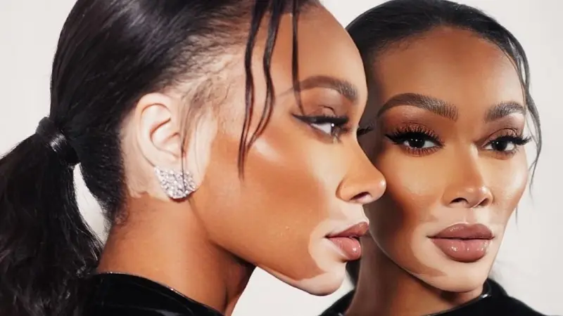 كيف تعلم بدء إصابتك بالبهاق؟