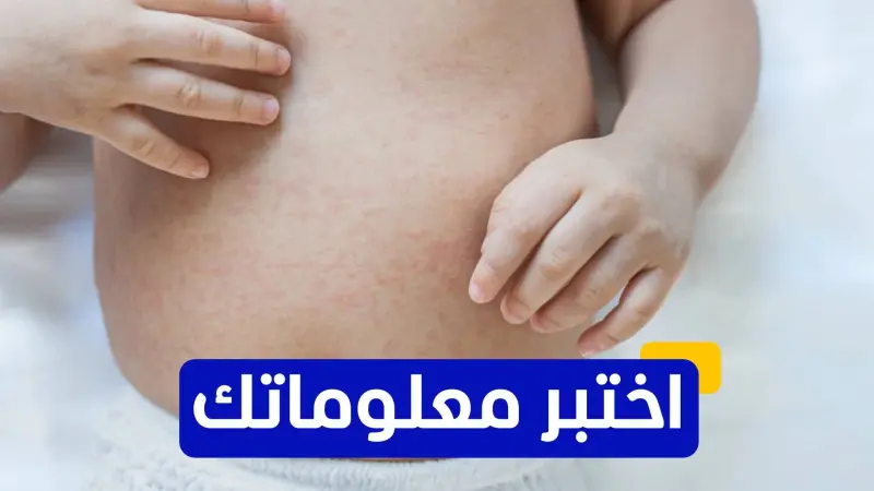 اختبر معلوماتك - أين تم تسجيل أول حالة موثقة للحصبة في التاريخ؟