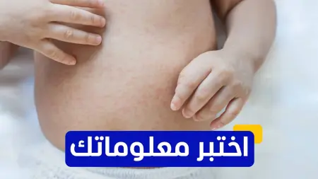 related_news_inside_blogsاختبر معلوماتك - أين تم تسجيل أول حالة موثقة للحصبة في التاريخ؟
