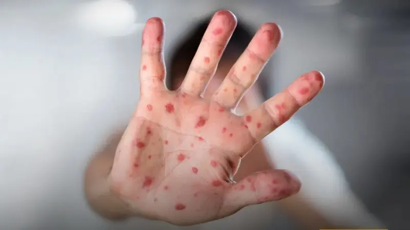 بعد موجة الهلع العالمي.. بيان وزارة الصحة في الجزائر عن جدري القرود