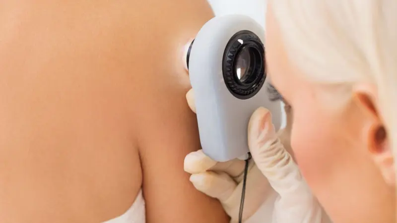 علاج وُلد في الفضاء.. ناسا تطور حقنة ضد سرطان الجلد