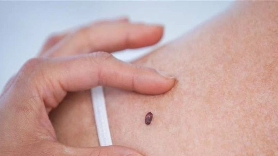متى تشكل الشامة خطرًا صحيًا؟ مؤشرات لا يجب تجاهلها 