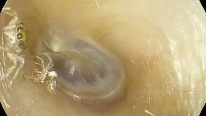 فيديو مرعب - لحظة اكتشاف طبيب لعنكبوت داخل أذن امرأة