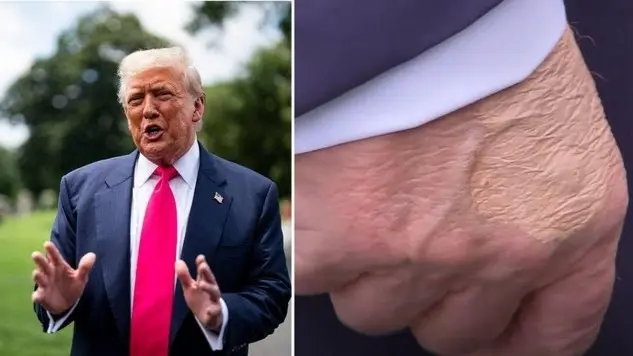 ما الذي يخفيه ترامب؟ كدمة جديدة تفتح باب التساؤلات