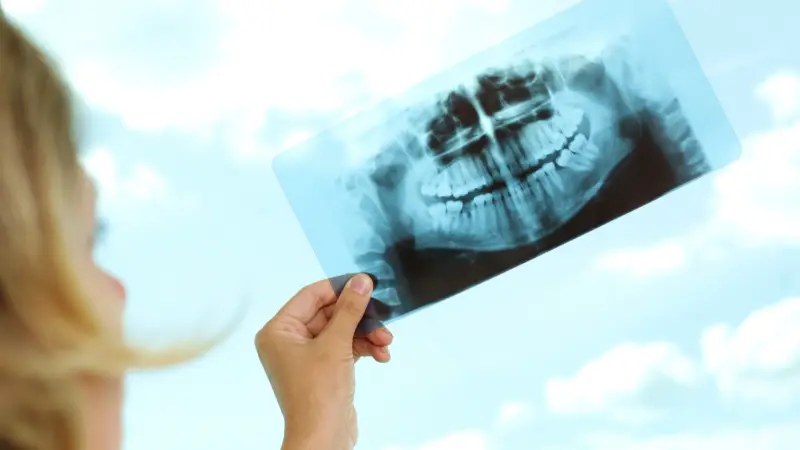 كلّ ما يجب معرفته عن زراعة الأسنان