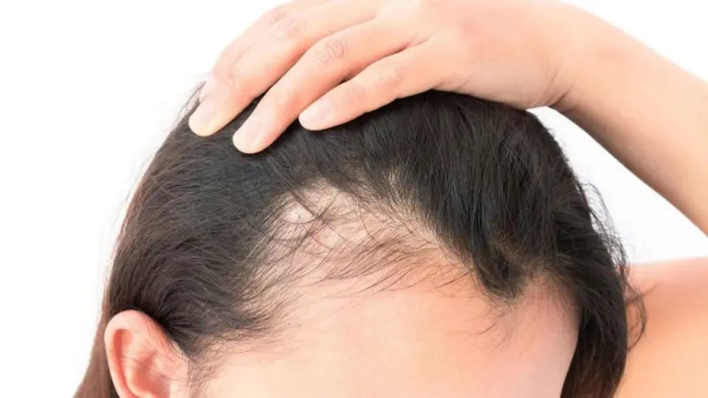 علاج الثعلبة الجسدية.. ما هو؟