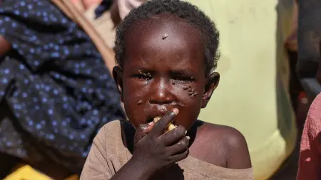 فيديو - أعراض مرعبة وأرقام صادمة لضحايا كيميائي البرهان في السودان
