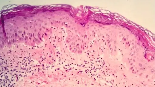 الذئبة الحمراء.. ما أعراضها؟