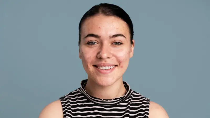 لاصقة طبية جديدة تعد بعلاج أسرع لحب الشباب