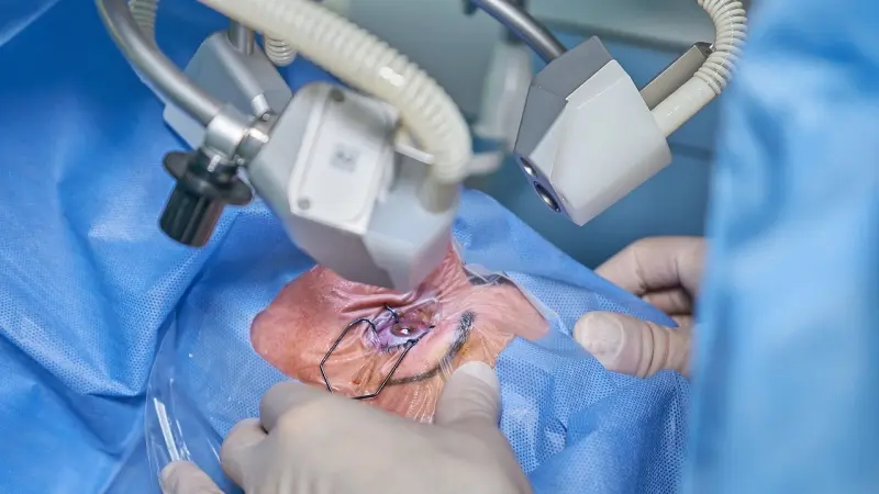 هل تشعر بالجفاف بعد عملية تصحيح البصر؟ طبيب يوضح الأسباب