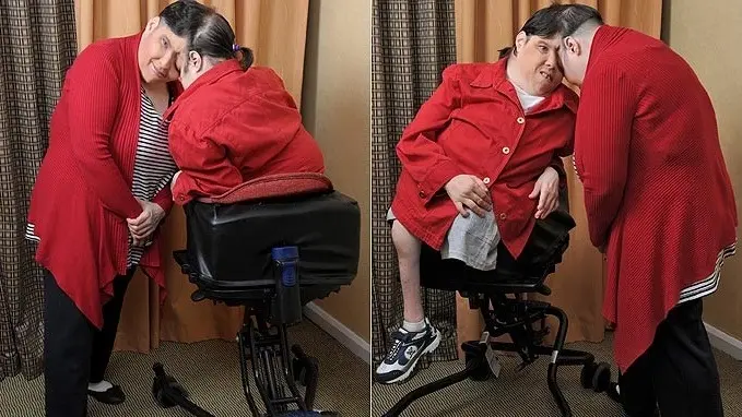 وفاة أكبر توأم ملتصق في العالم عن عمر 62 عاما