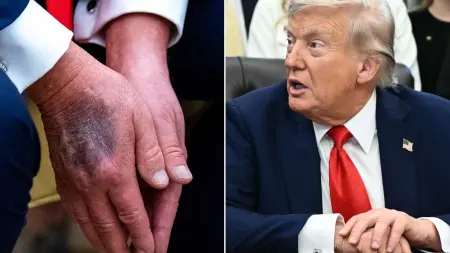related_news_inside_blogsترامب يكشف عن سبب ظهور الكدمات على يديه