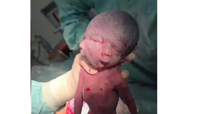 حالة نادرة.. ولادة طفل بوجهين في العراق