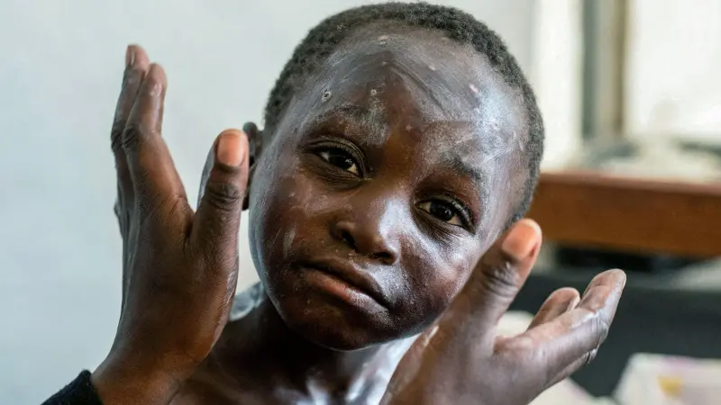 الصحة العالمية: جدري القرود لم يعد حالة طوارئ صحية دولية