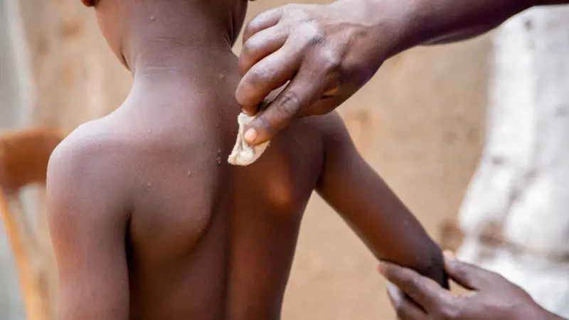 الصحة العالمية: ارتفاع عدد الإصابات بجدري القرود في إفريقيا