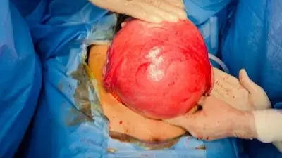 يزن 8 كيلوغرامات.. إزالة ورم ليفي رحمي من امرأة بنجاح