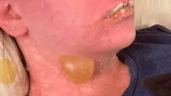 related_news_inside_blogsدواء شائع يتحول إلى كارثة.. تفاعل نادر يشوه وجه سيدة