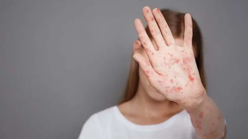 تفشي مرض الحصبة في ولايات أميركية مع تسجيل 123 إصابة