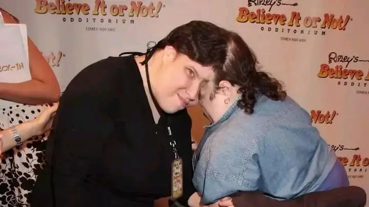 لم ير أحدهما الآخر.. هذا سبب وفاة أكبر توأمين ملتصقين