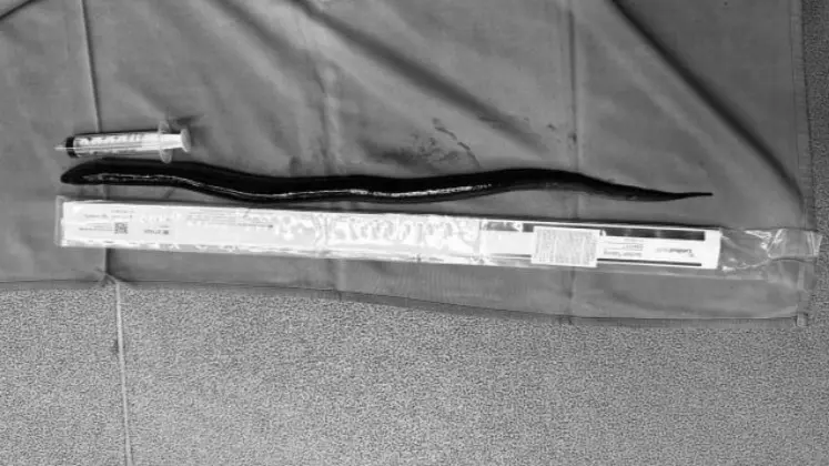 إزالة ثعبان بحر حي بطول 12 سنتمترا من بطن رجل