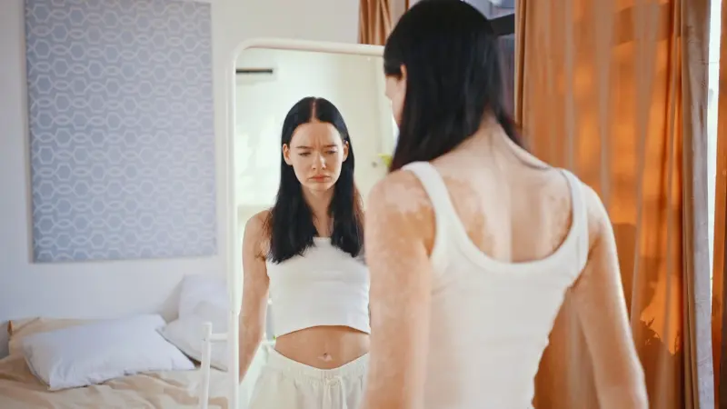 هل البهاق يسبب الاكتئاب؟