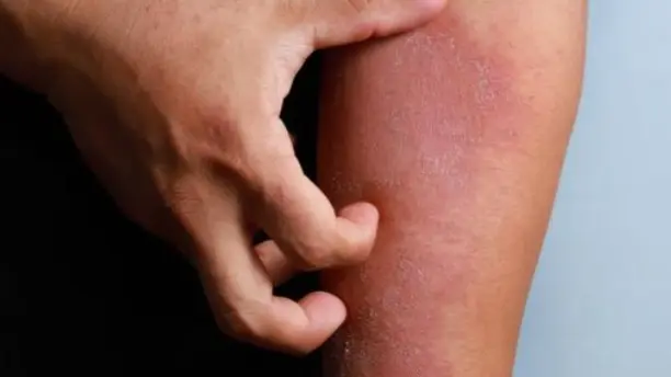 ارتفاع إصابات الجرب في الأردن.. هل خرج عن السيطرة؟