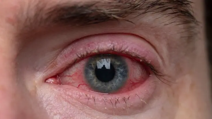 ما سبب احمرار العين اليسرى؟