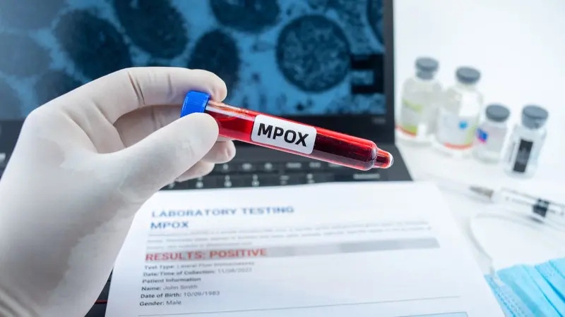 ينتقل عبر ممارسة الجنس.. الإصابة بجدري القرود تسبب الإجهاض