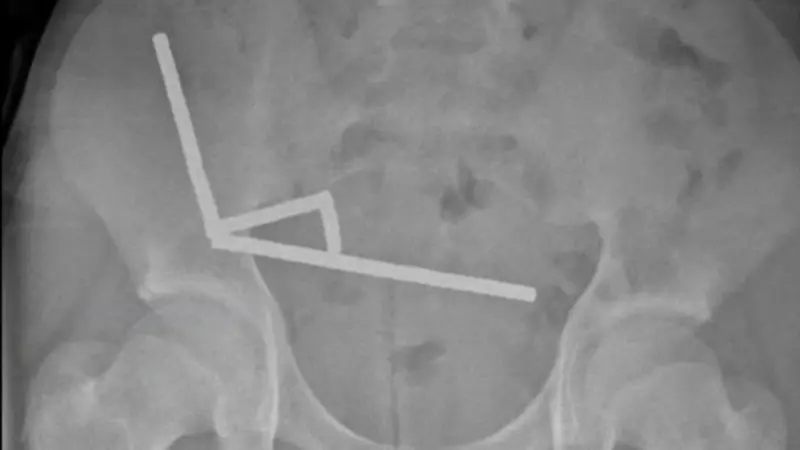 صبي يبتلع 200 مغناطيس في نيوزيلندا.. ما القصة؟