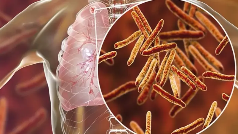 يثير قلقاً عالمياً.. كل ما يجب معرفته عن مرض السل