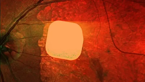 ابتكار مذهل.. شريحة إلكترونية تعيد البصر للمكفوفين