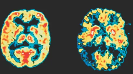 related_news_inside_blogsجزيئات البلاستيك في الدماغ أعلى بـ5 مرات لدى مرضى الخرف