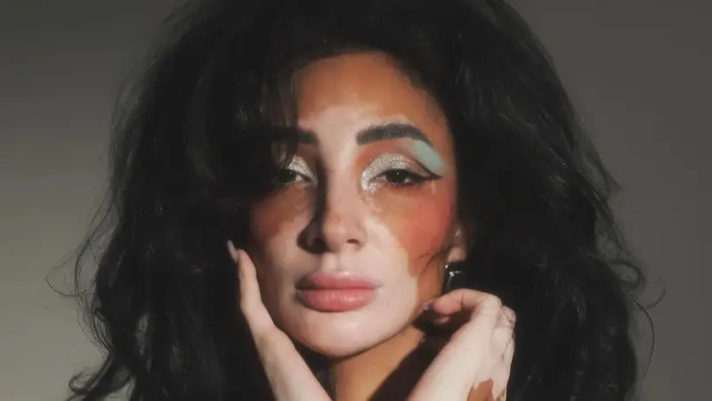 من هي لوجينا صلاح التي تحولت من مرض بهاق لملكة جمال الكون؟