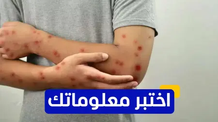 related_news_inside_blogsاختبر معلوماتك عن فيروس جدري القرود