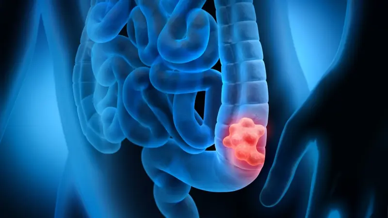 "تسونامي" سرطان الأمعاء.. القاتل الأول لمن دون الـ50
