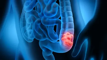 related_news_inside_blogs"تسونامي" سرطان الأمعاء.. القاتل الأول لمن دون الـ50