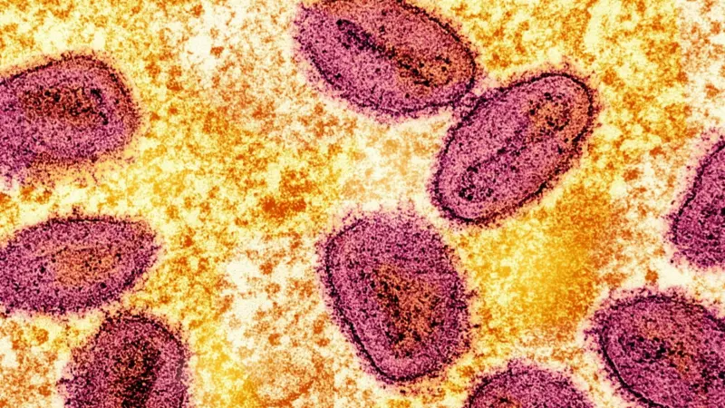 في كاليفورنيا.. تسجيل أول إصابة بالسلالة 1 من جدري القرود