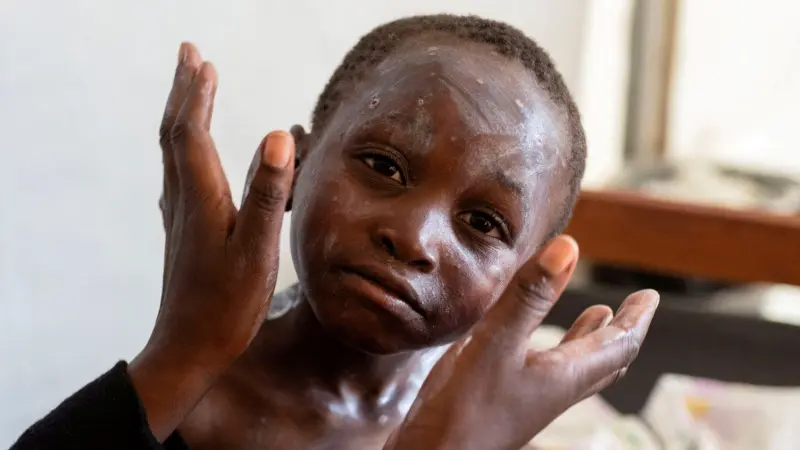 إصابتان جديدتان بجدري القرود في هذه الدولة