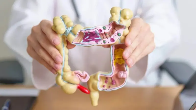 طريقة واعدة من كوريا لإبطاء سرطان القولون