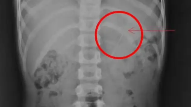طوله 10 سم.. طفل يبتلع قلم رصاص وهذا ما حدث