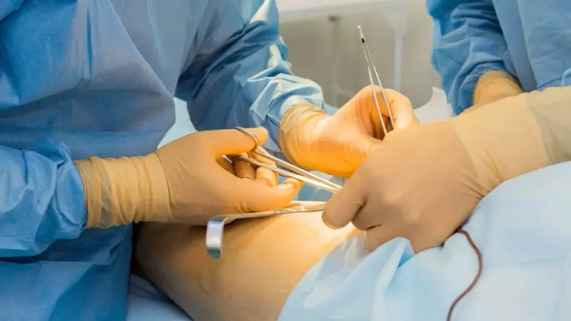 فيديو - تكميم المعدة "جريمة".. أخصائي سمنة وتغذية يشرح الأسباب